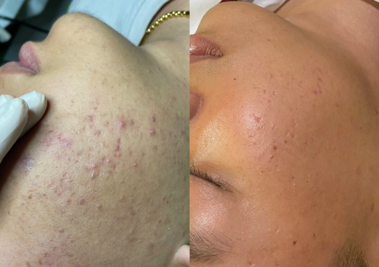 Trị mụn chuẩn y khoa tại Bảo Lộc